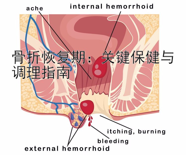 骨折恢复期：关键保健与调理指南